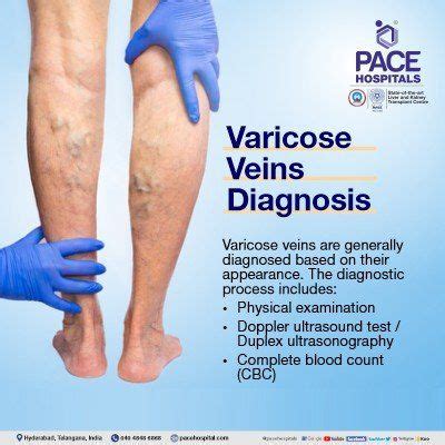 Varicose Veins Diagnosis