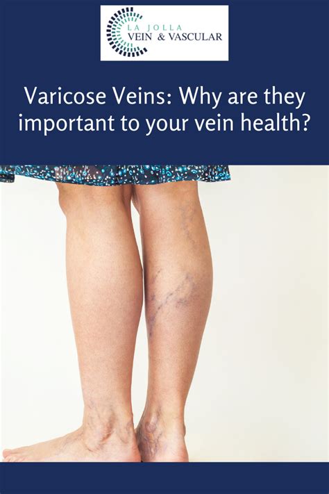 Varicose Veins Living