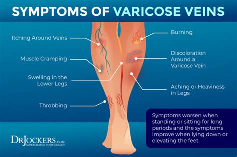 Varicose Veins Symptoms
