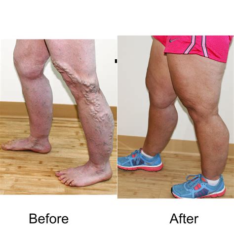 Varicose Veins Treatment