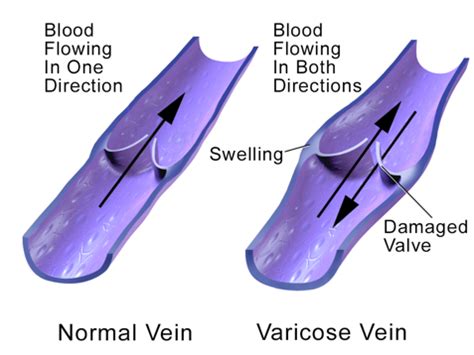 varicose veins treatment options