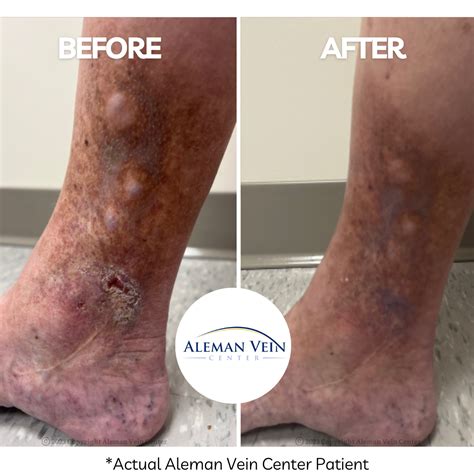Venous Ulcer Healing Process