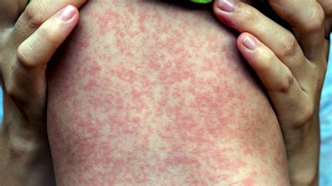 viral rashes