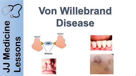 Von Willebrand disease symptoms