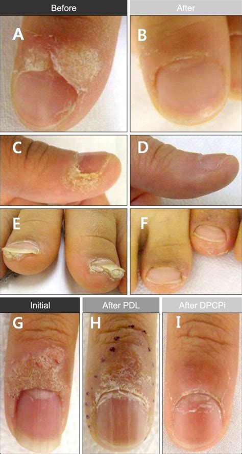 wart on finger removal
