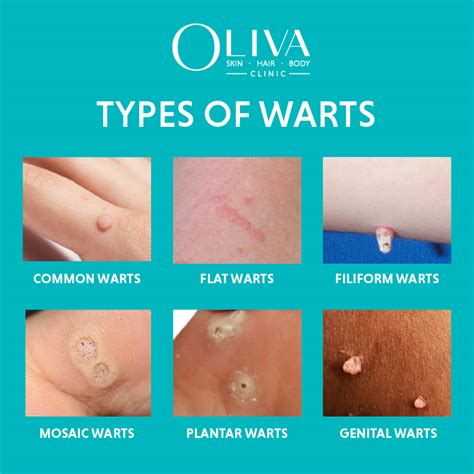 wart prevention tips