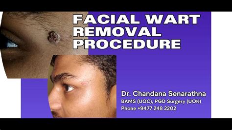 wart removal procedures