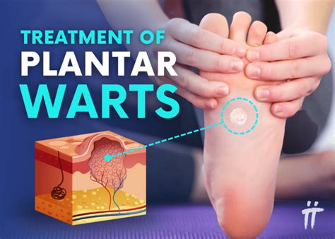 wart treatment options