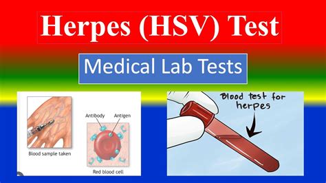 what to expect after an hsv blood test