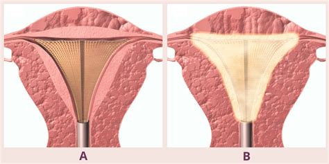 what to expect during endometrial ablation