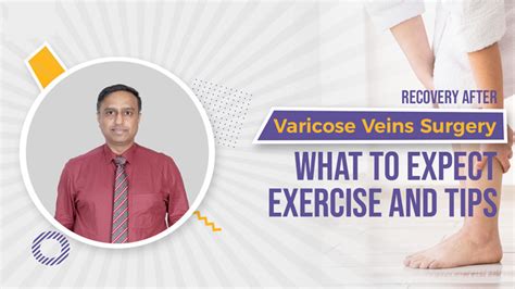 what to expect from varicose vein removal