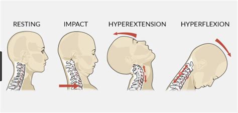 Whiplash Injury Causes