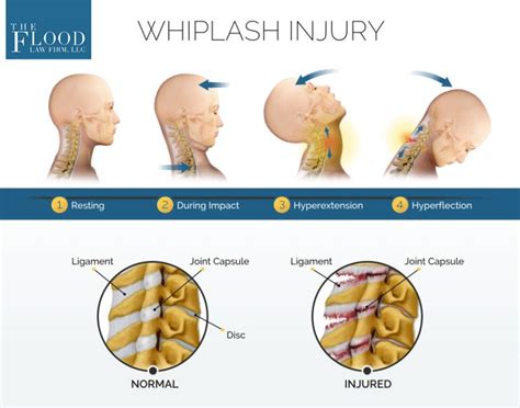 Whiplash Injury Conclusion