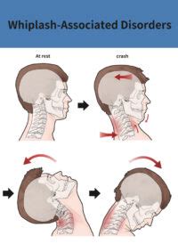 Whiplash Injury Treatment