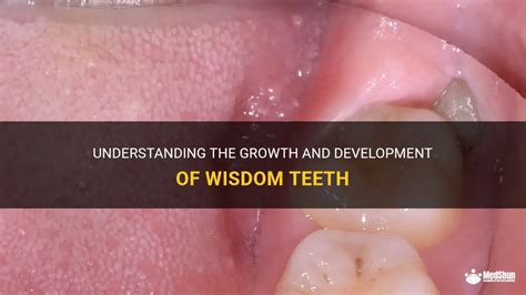 Wisdom teeth development stages