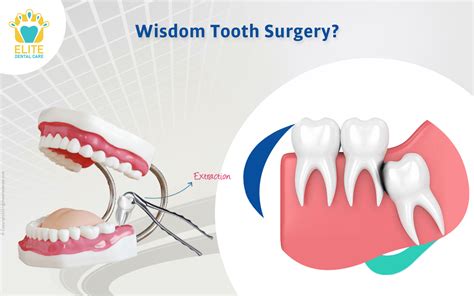 The role of wisdom teeth in oral health