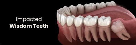 Wisdom Tooth Complications