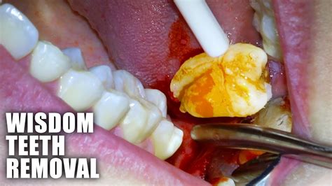 Wisdom Tooth Extraction