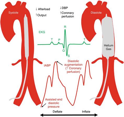 Working Mechanism of Intra-Aortic Balloon Pump Therapy