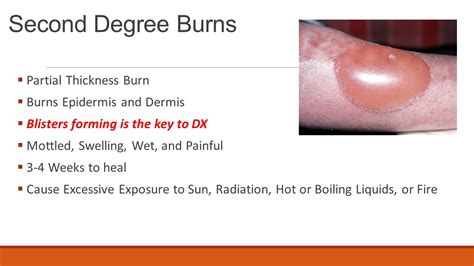 wound care for 2nd degree burns