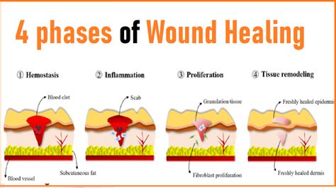 wound healing