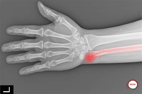 wrist fracture complications